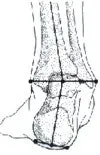 Superfeet Comfort Hockey Skate Footbeds